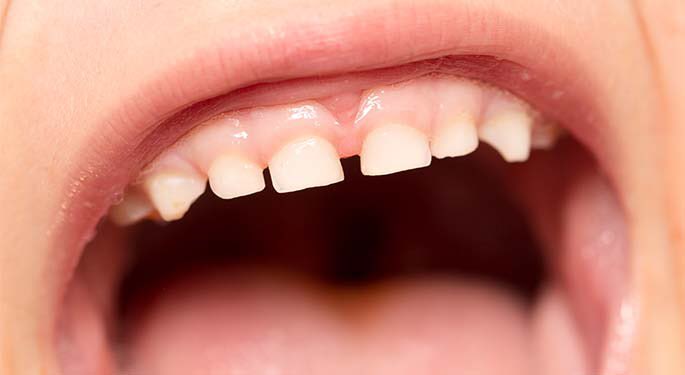A close up of a person's mouth with teeth.