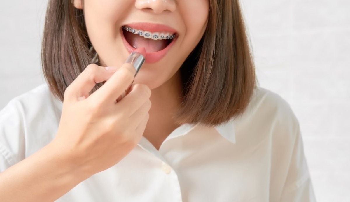 Quiz: What Color Braces Should I Get? 5 Trending Color Idea 19