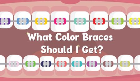 Quiz: What Color Braces Should I Get? 5 Trending Color Idea