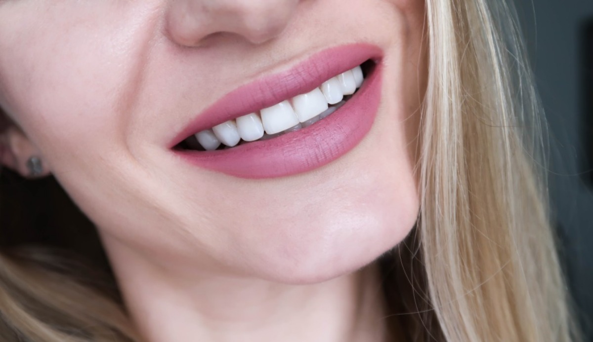 Quiz: What Color Braces Should I Get? 5 Trending Color Idea 3